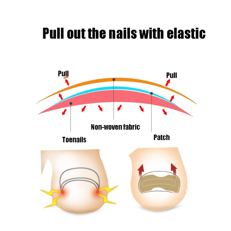 10 PCS Glue-free Orthopedic Nail Stick Toe Nail Groove Inlay Corrector