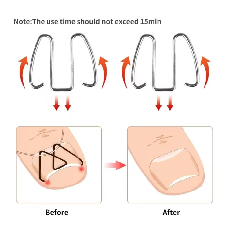 6pcs /Box Ortho Wire Nail Insertion Orthotic Toe Nail Ortho Hooks